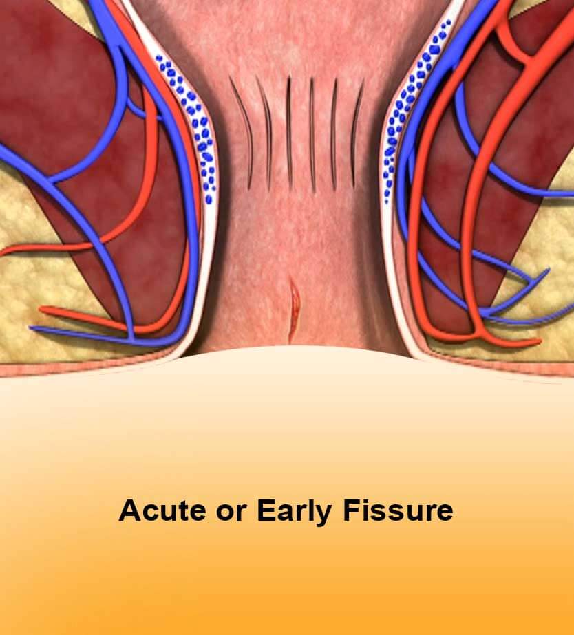 Acute or early Fissure