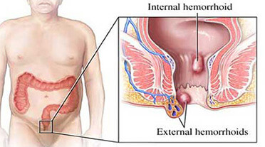 internal external hemorrhoids and piles treatment
